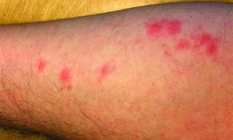 Pola garis lurus gigitan kutu kasur pada lengan