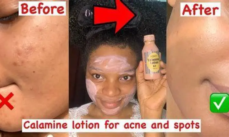 Mengoleskan losion untuk gigitan kutu kasur