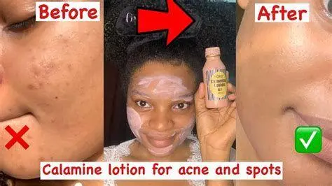 Pengobatan Gigitan Kutu Kasur Mengoleskan losion untuk gigitan kutu kasur