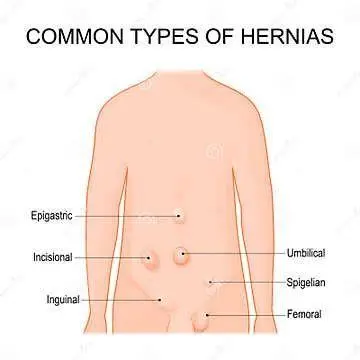 Visualisasi Jenis Hernia Diagram jenis-jenis hernia pada tubuh