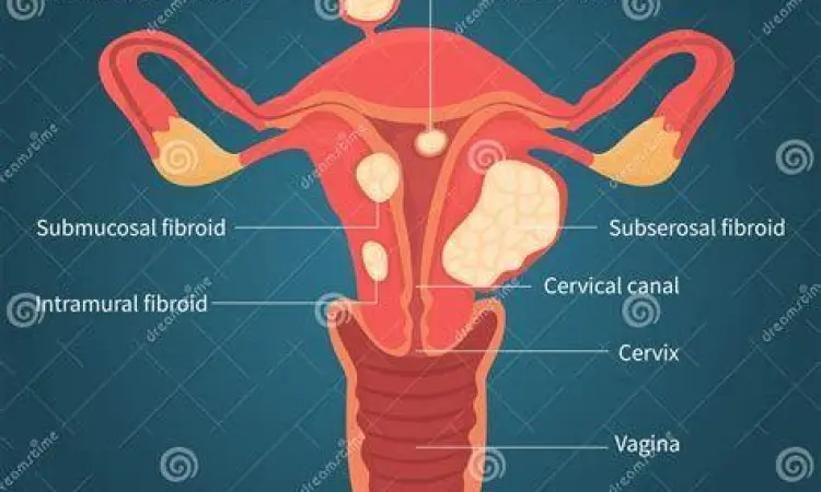 Diagram Miom Rahim Diagram miom dalam rahim penyebab darah haid kental