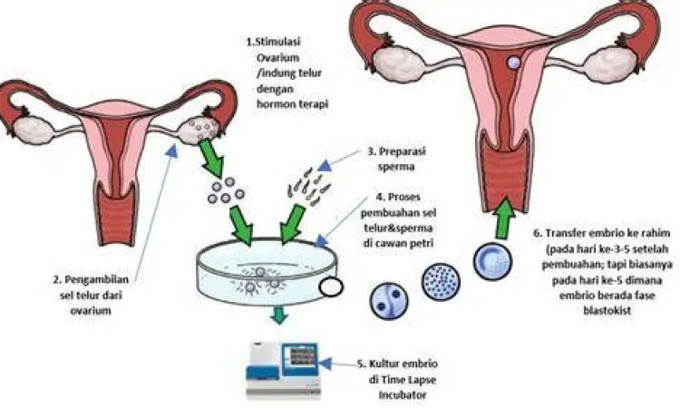 Proses mikromanipulasi sperma pada program bayi tabung