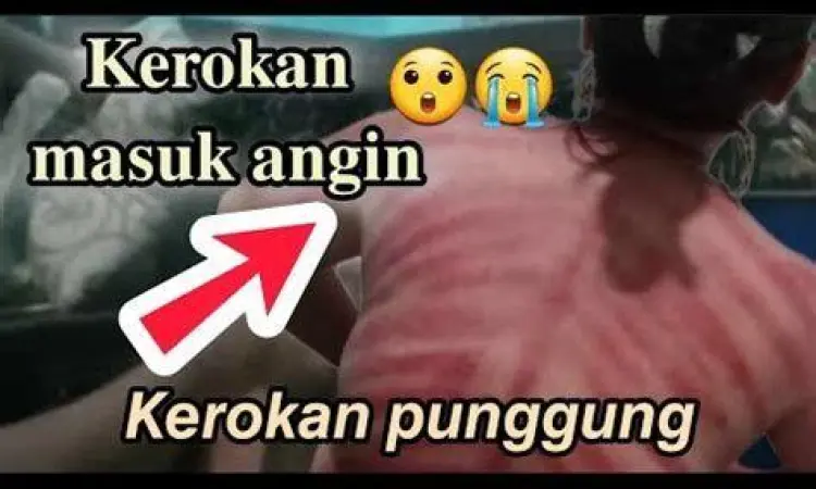 Teknik Kerokan Teknik kerokan tradisional untuk masuk angin