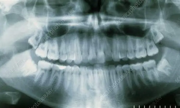 Rontgen Panoramik Gigi Hasil rontgen panoramik gigi geraham ketiga