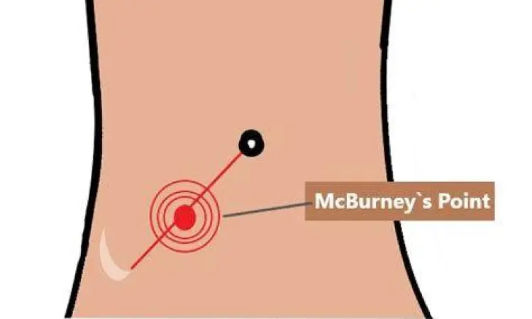 Lokasi titik nyeri McBurney pada perut kanan bawah