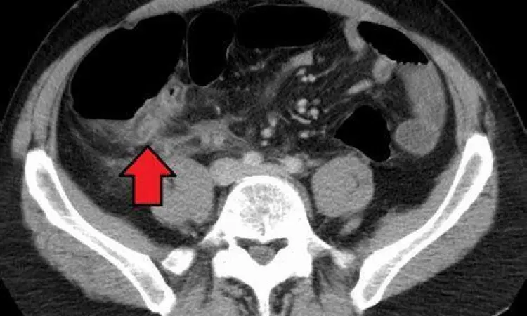 Diagnosis Imaging Usus Buntu Hasil CT scan menunjukkan peradangan pada usus buntu