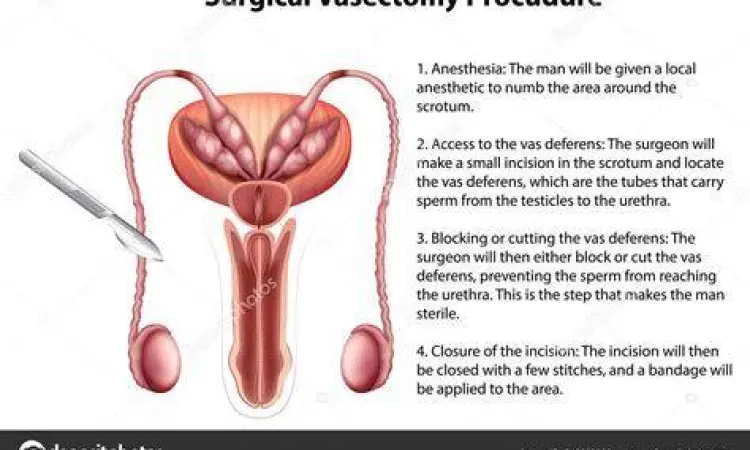 Prosedur bedah minor vasektomi pada saluran vas deferens