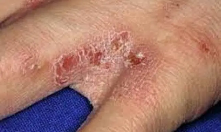 Bintil kemerahan akibat scabies pada sela jari tangan