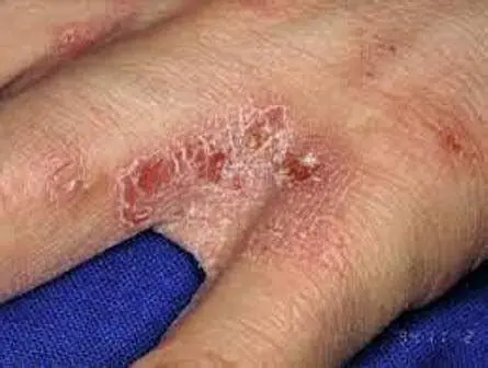 Gejala Scabies Sela Jari Bintil kemerahan akibat scabies pada sela jari tangan