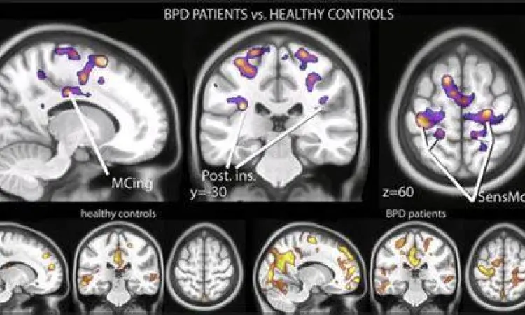 Neurobiologi BPD Perbedaan aktivitas otak pada penderita borderline personality disorder