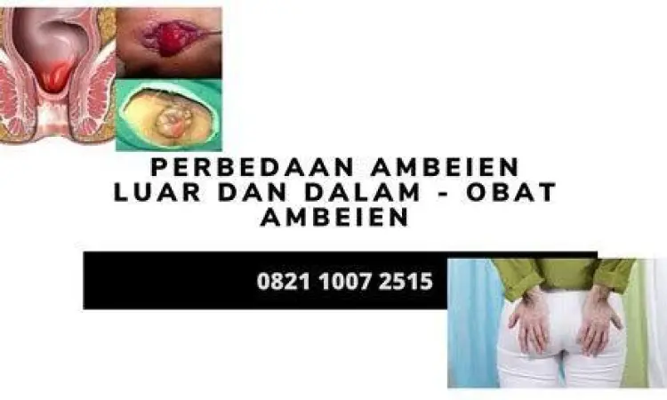 Visualisasi Ambeien Luar Gambar ambeien luar pada stadium awal