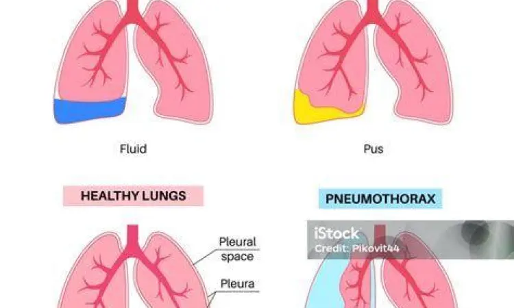 Anatomi Efusi Pleura Perbandingan anatomi pleura normal dan efusi pleura