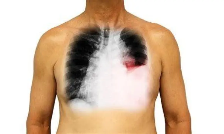 Pasien mengalami sesak napas akibat efusi pleura