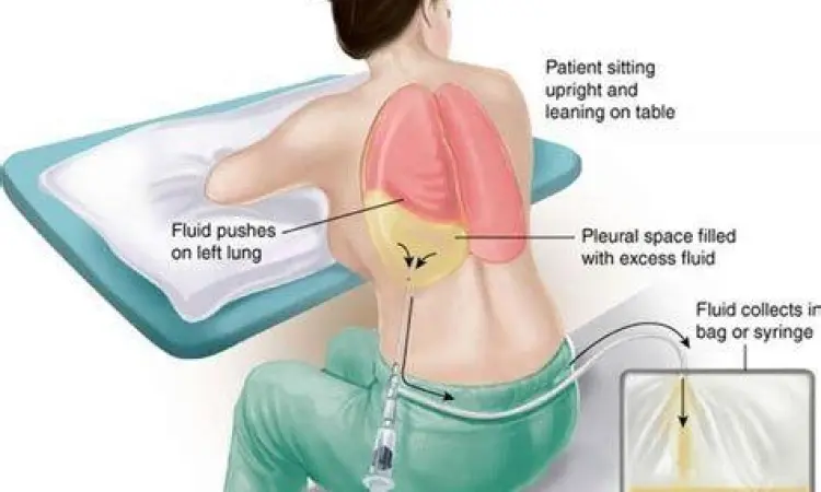 Prosedur Torakosentesis Prosedur pengambilan cairan paru atau torakosentesis