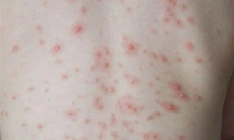 Gejala cacar air fase awal berupa bintik merah