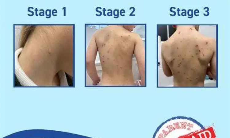 Tahapan Perkembangan Ruam Cacar Air Perkembangan vesikel menjadi krusta pada gejala cacar air