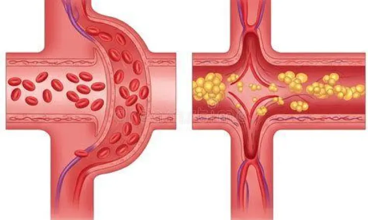 Perbandingan arteri sehat dan arteri yang tersumbat plak