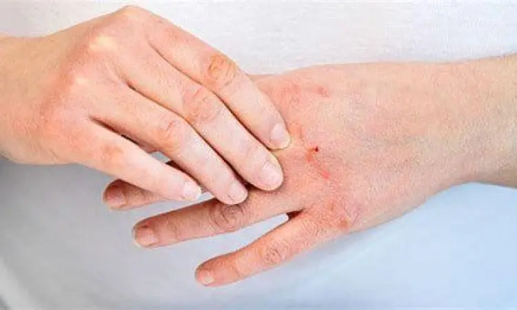 Gejala ruam merah pada tangan akibat alergi kontak