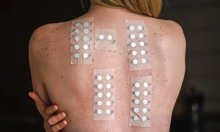 Tes Tempel Kulit Prosedur tes tempel kulit untuk diagnosis alergi