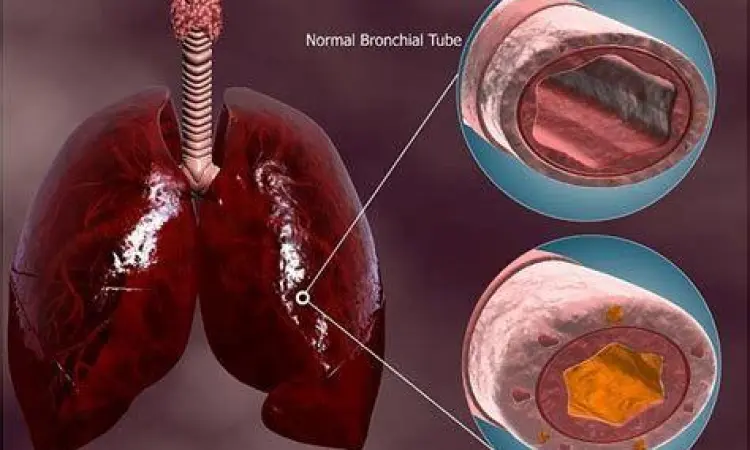 Anatomi Bronkitis Perbandingan bronkus normal dan bronkus yang mengalami inflamasi