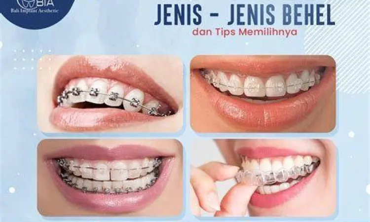 Perbandingan jenis bracket behel gigi metal dan keramik