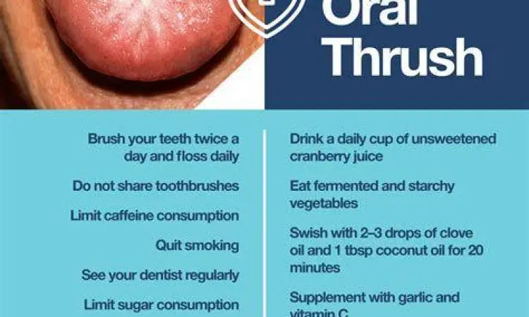 Gejala Oral Thrush Gejala oral thrush pada permukaan lidah