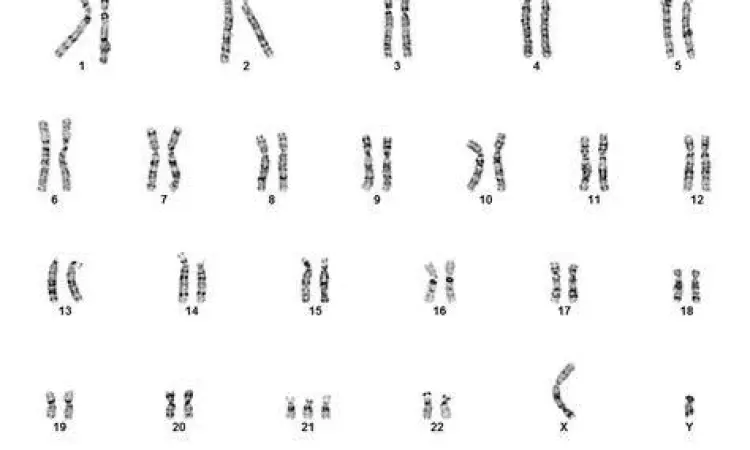 Diagram kromosom trisomi 21 penyebab down syndrome