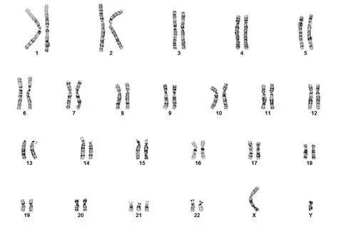 Struktur Kromosom Down Syndrome Diagram kromosom trisomi 21 penyebab down syndrome