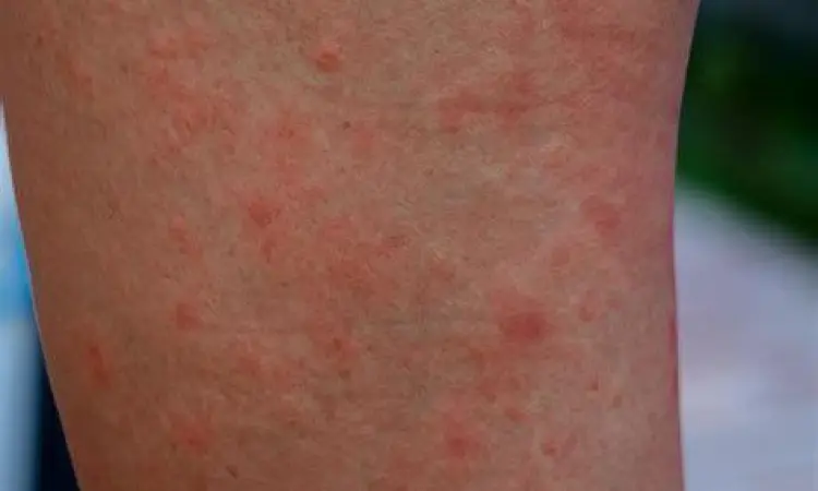 Gejala Alergi Kulit Gejala alergi kulit yang mereda dengan cetirizine