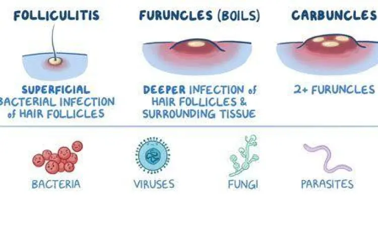 perbedaan bisul tunggal dan kumpulan bisul karbunkel