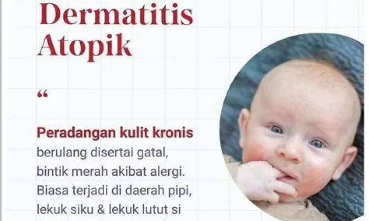 Gejala Visual Eksim Tampilan visual peradangan kulit akibat eksim