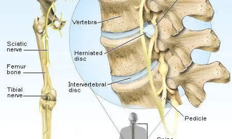 Anatomi diskus tulang belakang yang mengalami HNP