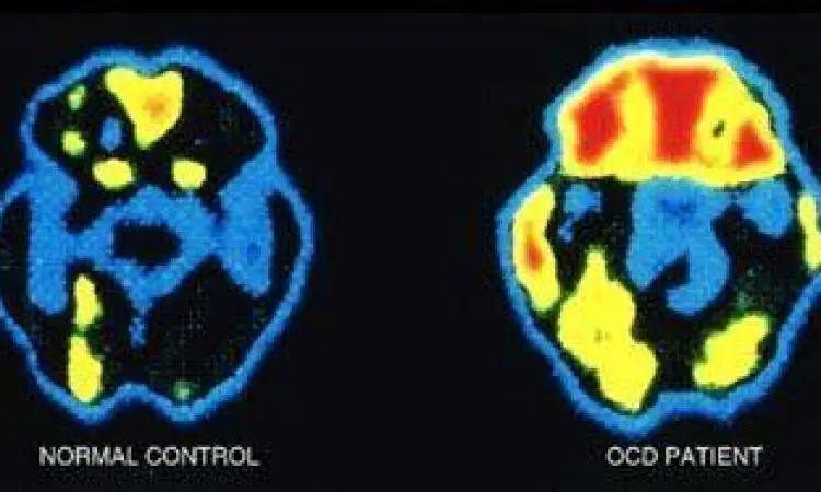 Aktivitas Otak pada OCD Perbandingan pemindaian otak penderita OCD dan orang normal
