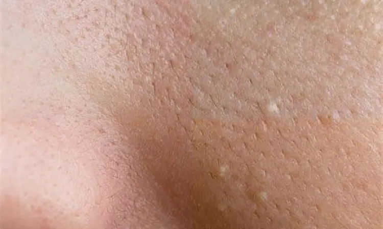 Kondisi Kulit Milia Tampilan dekat milia pada kulit wajah