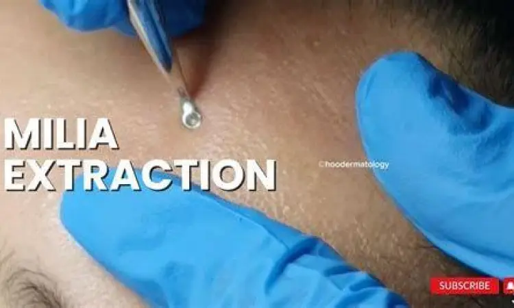 Prosedur Medis Milia Prosedur ekstraksi milia oleh dokter kulit