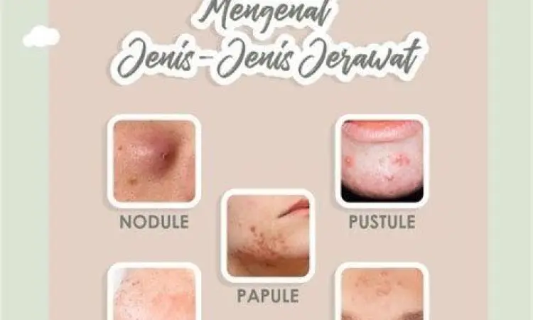 Visualisasi jenis jerawat dan cara penanganan yang tepat