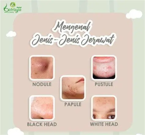 Mengenal Jenis Jerawat Visualisasi jenis jerawat dan cara penanganan yang tepat