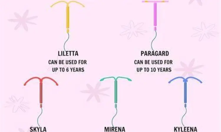 Ilustrasi berbagai jenis IUD tembaga dan hormonal