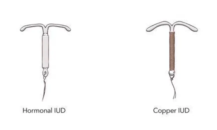 Ukuran IUD dibandingkan dengan koin