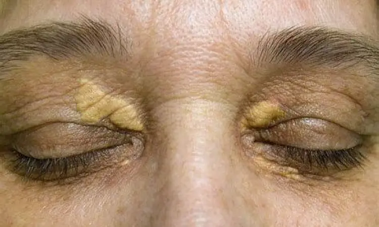 Xanthelasma Gejala Kolesterol Endapan lemak xanthelasma di sekitar mata