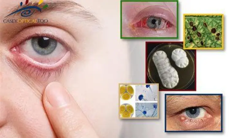 Gejala Infeksi Mata Gejala infeksi bakteri pada mata yang memerlukan antibiotik