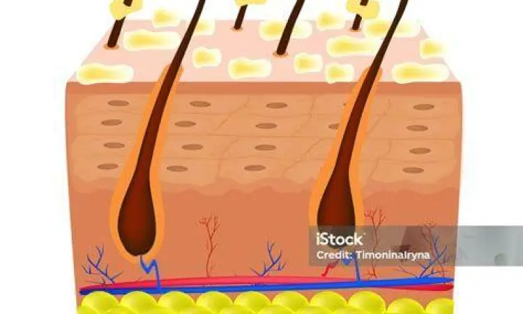Ilustrasi anatomi kulit kepala yang mengalami ketombe