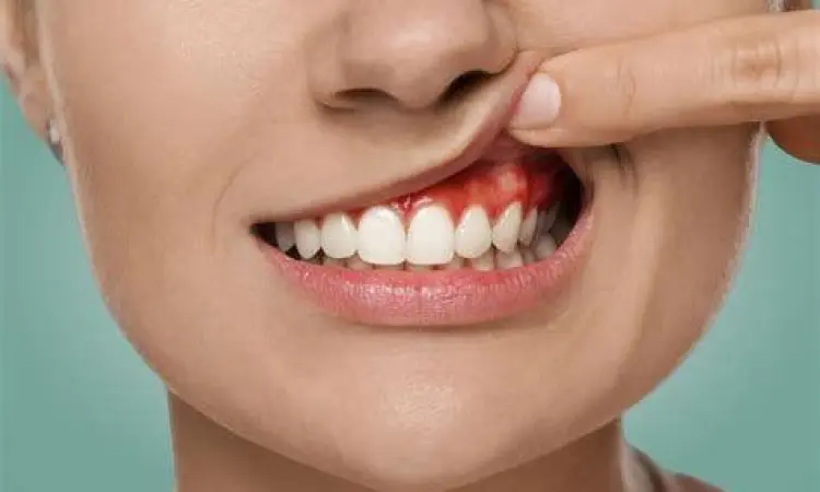 Penyebab utama sariawan di gusi dan mulut