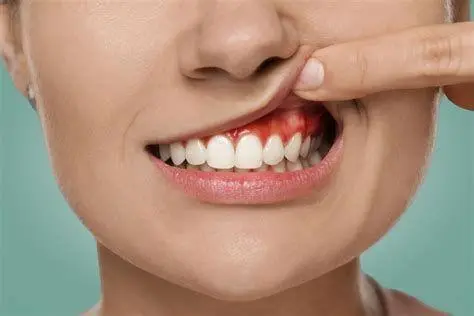 Penyebab Sariawan Gusi Penyebab utama sariawan di gusi dan mulut