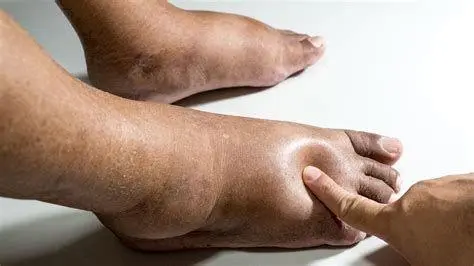 Pembengkakan Kaki Edema pembengkakan kaki akibat gangguan ginjal