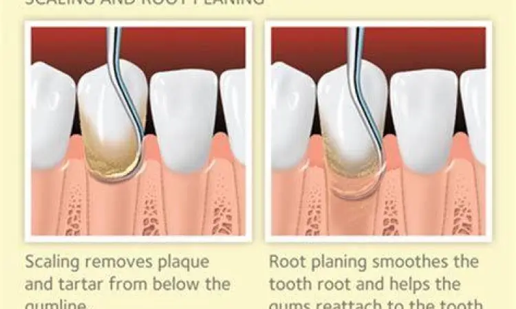 Prosedur Scaling Gigi Tahapan prosedur scaling gigi oleh dokter
