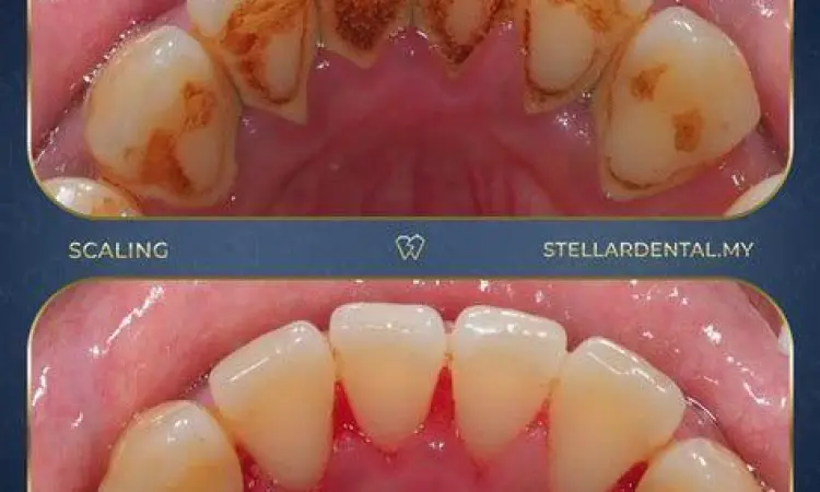 Hasil Scaling Gigi Perbandingan karang gigi sebelum dan sesudah scaling