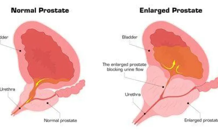 Perbandingan prostat normal dan prostat yang mengalami pembengkakan