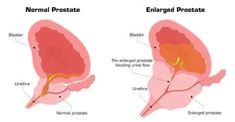 Kondisi Prostat Perbandingan prostat normal dan prostat yang mengalami pembengkakan