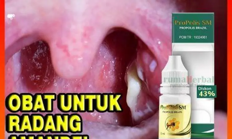 Obat Farmasi Amandel Berbagai jenis obat pereda radang amandel
